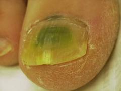 Uncommon Fungus Infections of the Great Toe